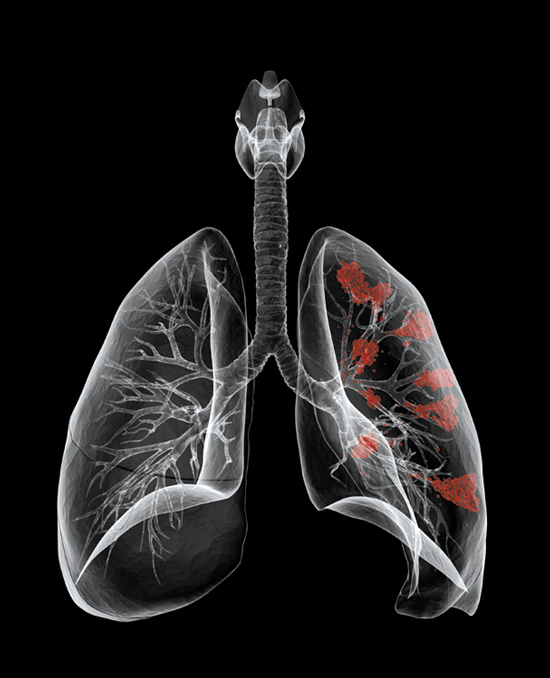 咳嗽变异性哮喘该如何治疗