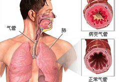 变异性哮喘症状有哪些？