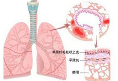 变异性哮喘的病因是什么