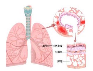 详解职业性哮喘的知识